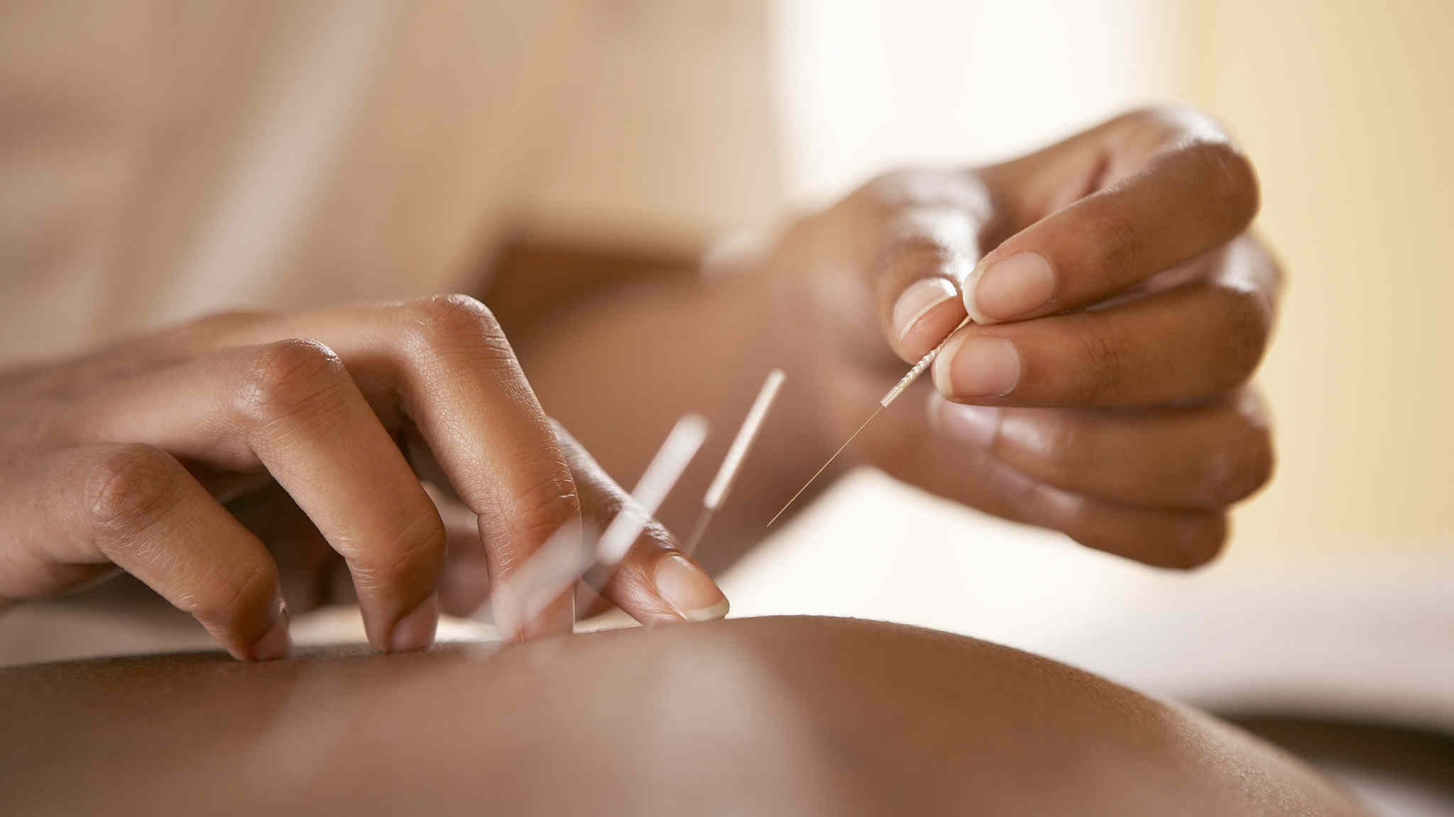 Acupuncture treatment